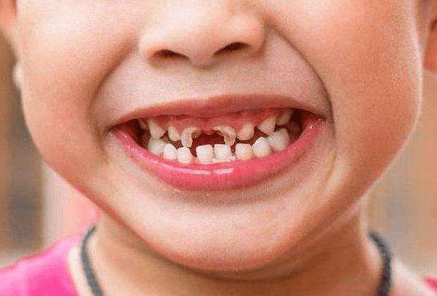 5岁孩子满口＂小黑牙＂,天天刷牙没效果？勿忽略＂1早3对＂