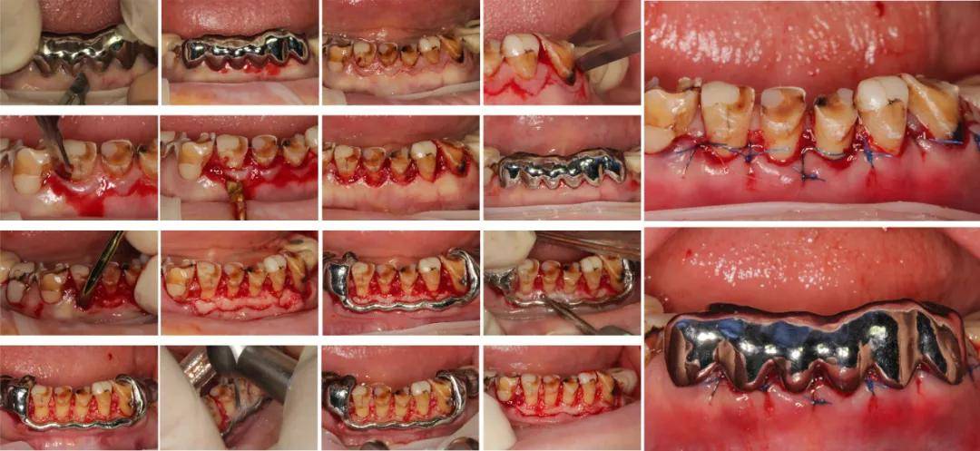 牙列重度磨耗伴牙列缺损患者的再次咬合及美学重建一例 口腔跨学科