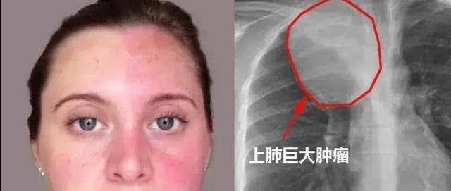 原创手皮肤眼脸出现这4个变化或这4种表现可能肺癌在靠近