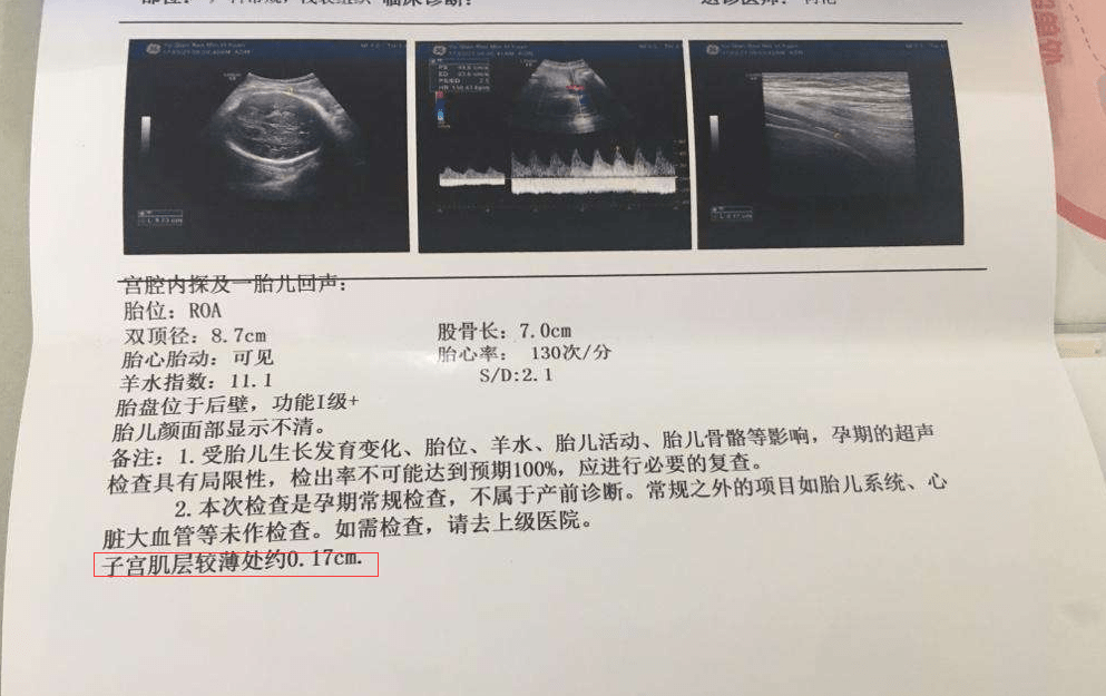 宝妈哺乳期意外怀孕,最终3年剖2娃,医生：不建议频繁剖宫产