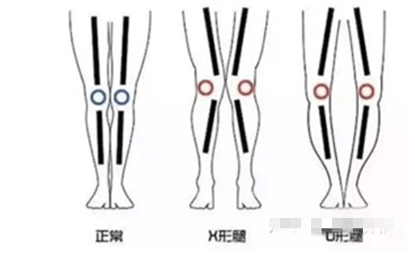 O型腿会遗传吗？父母注意：这几种情况下,腿型会遗传给下一代