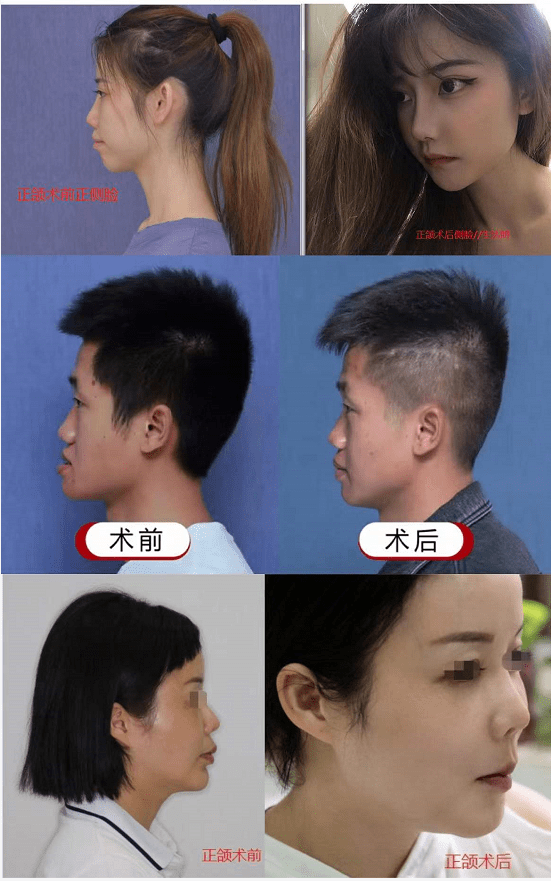 对比图,大家都可以翻来看看除了这类型的患者,在正颌术后能取得比较好