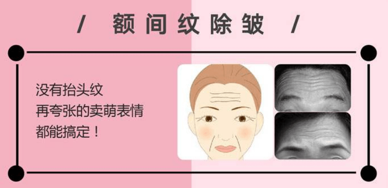 惊:川字纹除皱针的危害和副作用是真的有吗?打除皱针?