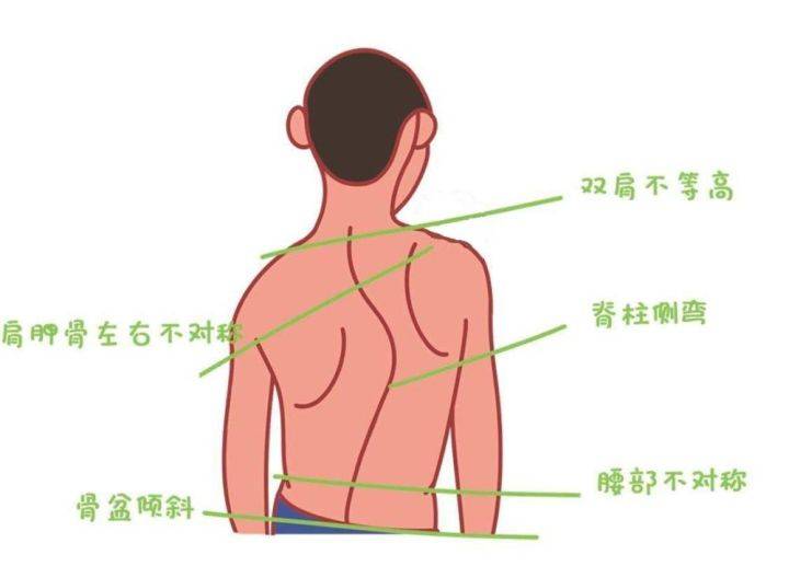 两侧肩膀高度不一致;女生在发育时出现双乳发育不对称;后背一侧有隆起