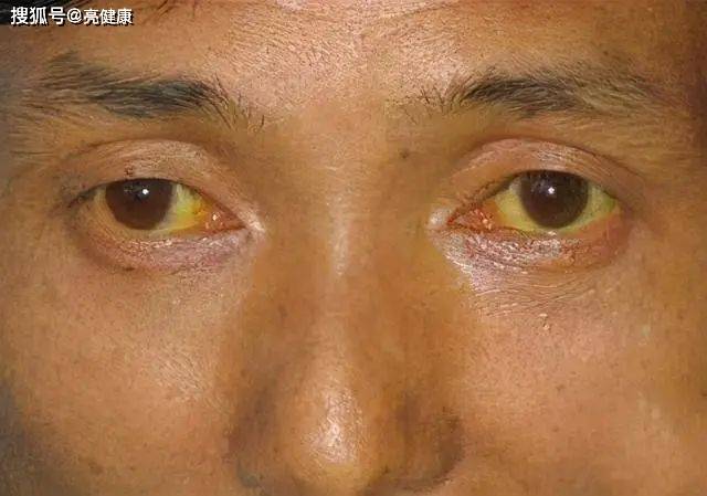 人黄是什么原因 来自搜狐网