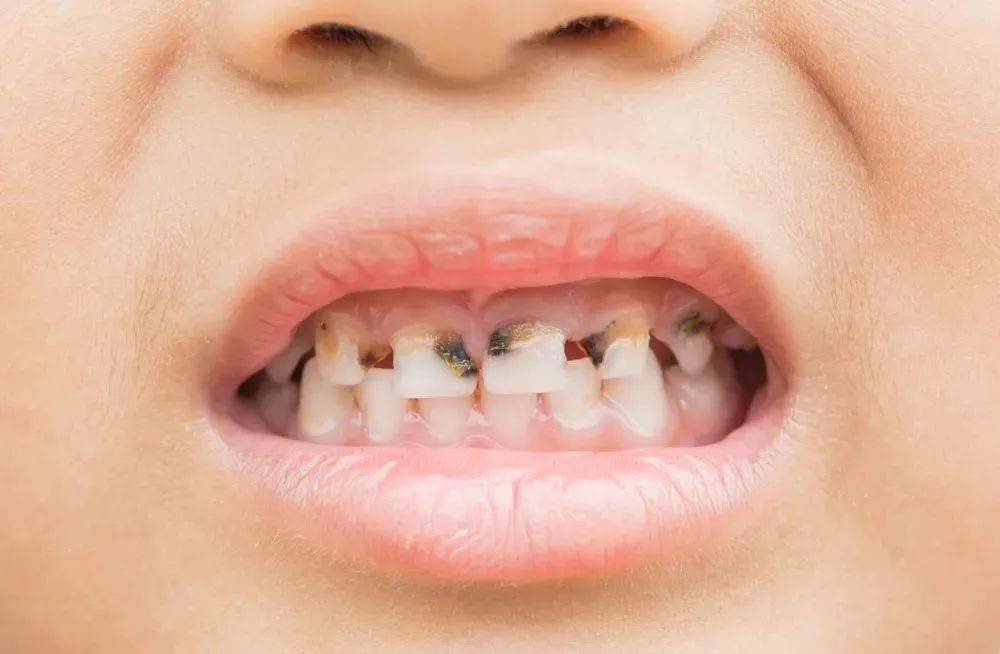 ＂乳牙龋＂不用治疗？家长别自以为然,伤害孩子身心健康