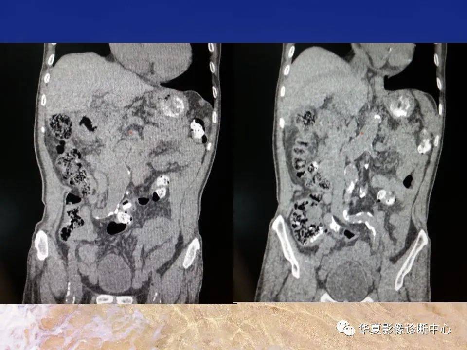 消化道穿孔ct影像大汇总看完印象深刻