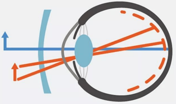图:近视离焦原理近视离焦镜片的优缺点相对于角膜塑形镜,近视离焦镜片