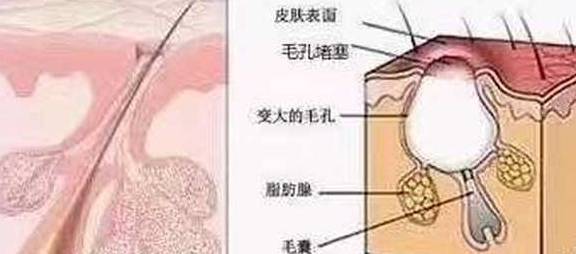 痤疮又称为普通粉刺,是一种皮肤病_痘痘_毛囊_皮脂腺