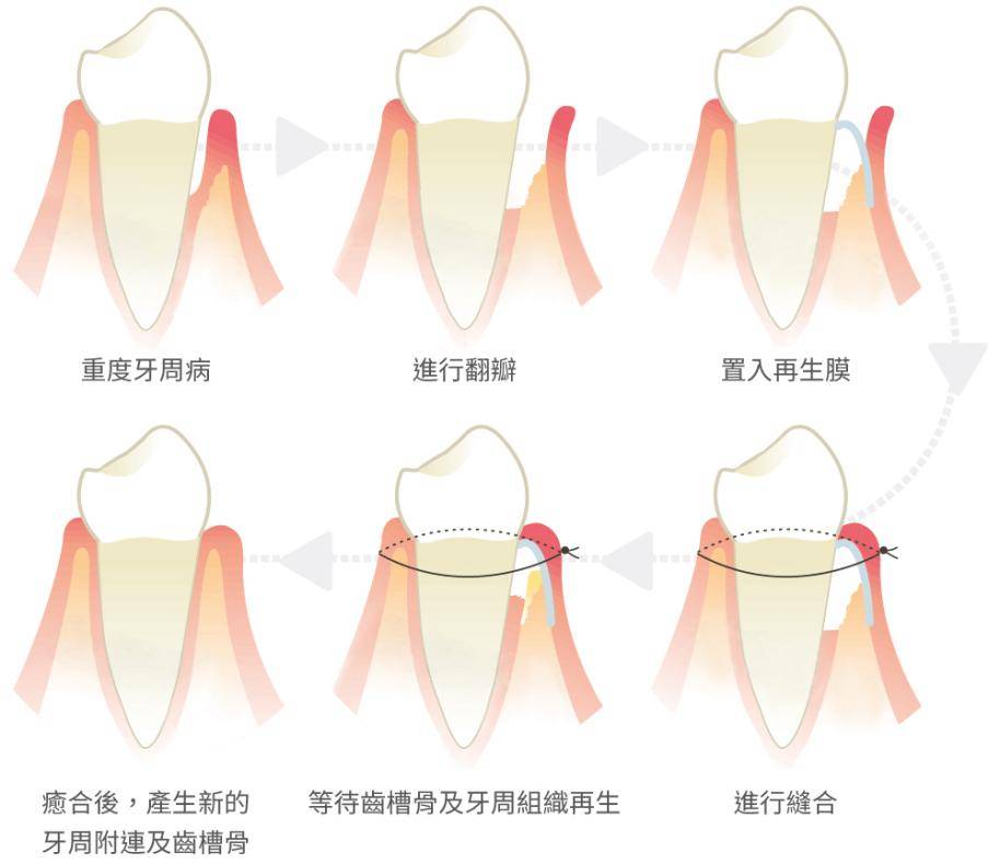 此时,洁牙和刮治已无法彻底清除牙周袋深部的感染物,需要进行牙周再生