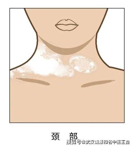 脖子突然白了一块是什么病不疼不痒武汉治疗皮肤病专科医院