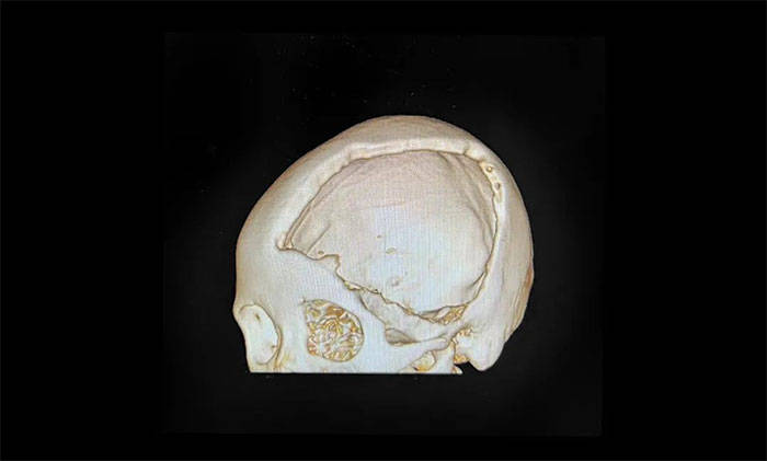 左侧颅骨大面积缺损于耀宇主任解释道,颅骨缺损不