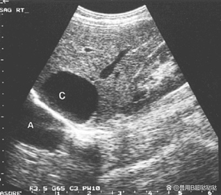 肝囊肿伪影在隔膜的另一侧在膀胱和胆囊中,旁叶伪影的一种变体是切片