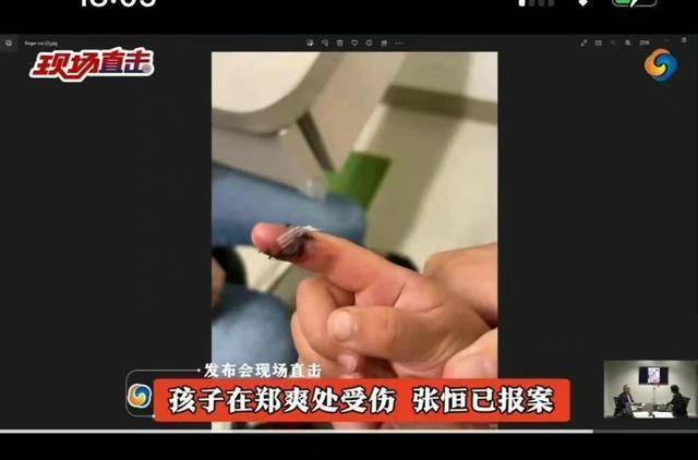 张恒爆料郑爽虐儿，申请美国贫苦白卡，孩子受伤照片曝光