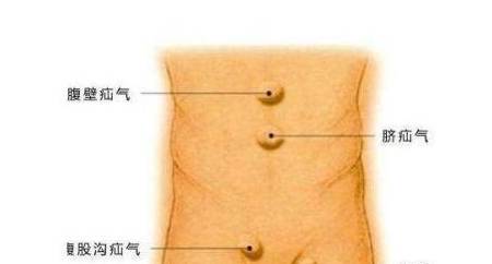 疝气是怎么样的呢？有什么特点呢？应该注意什么呢？