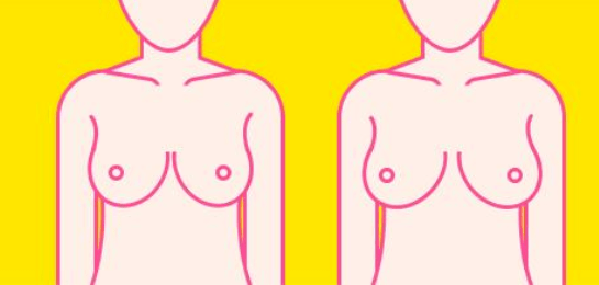 女性胸部外扩如何改善？
