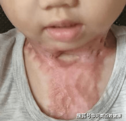 南院区烧伤中心疤痕无忧义诊手术——上海九院整形大咖加盟让您远离疤痕困扰丨上海第九人民医院烧伤科