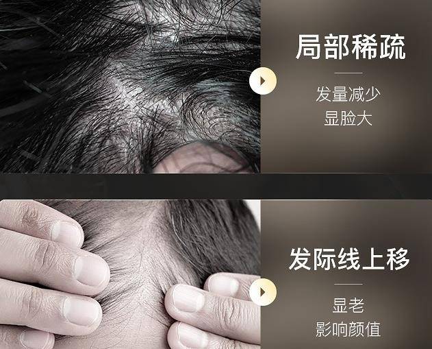 掉发严重用哪种洗发水效果好？真的没踩雷