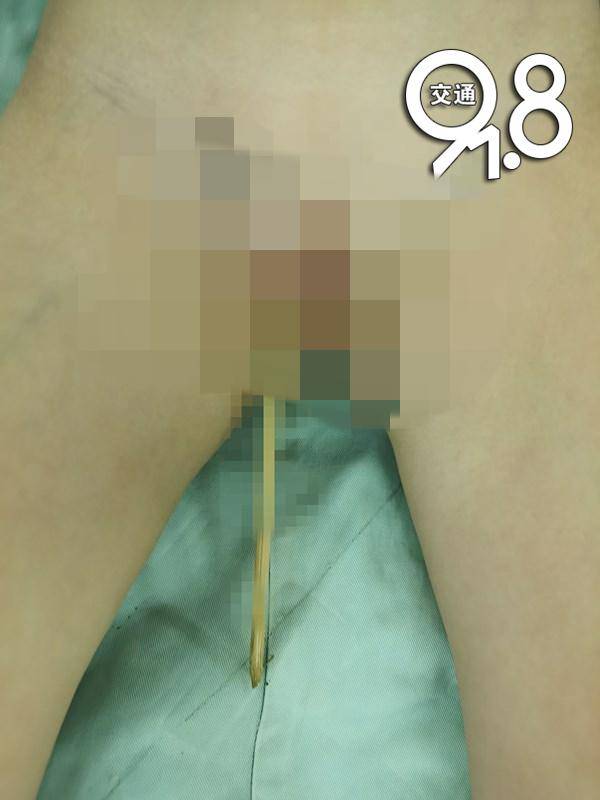 「小菲」抱来时……家长千万要注意3岁女童被竹签刺入