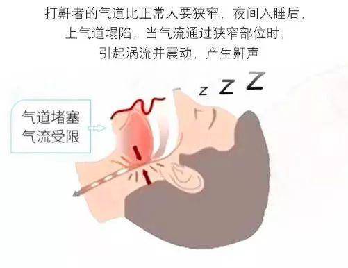 打呼噜慢性自杀教你一招鼾立停睡眠好了1000倍