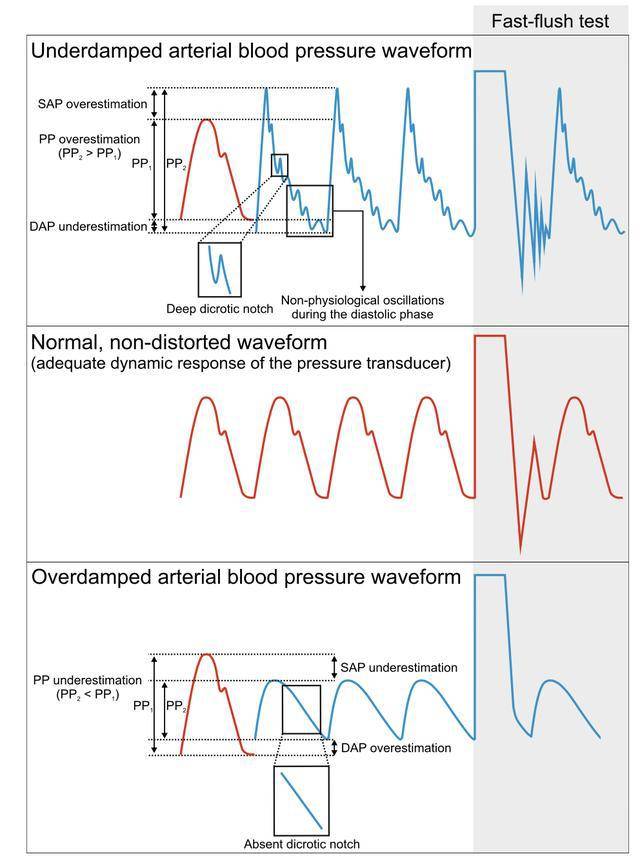 图3:阻尼不足,阻尼正常,阻尼过大时的波形与快速冲洗试验为了测试动脉