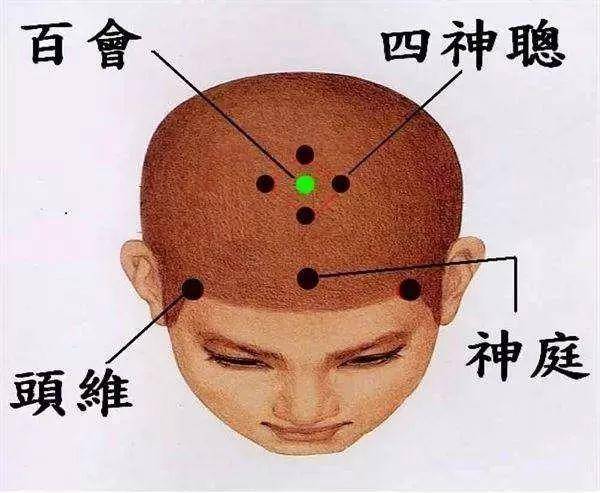 健忘失眠神经性头痛脑血管病后遗症恢复四神聪穴