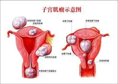 随着子宫肌瘤增大或者肌瘤生长在特殊部位时,常会引起子宫出血,腹部