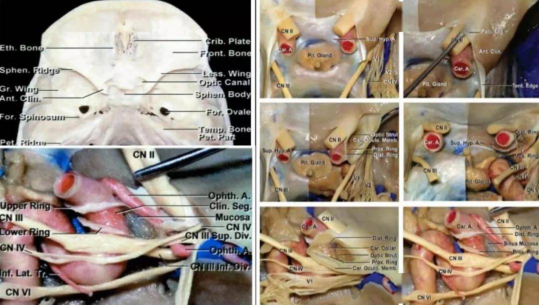 前床突及蝶骨小翼,蝶骨嵴脑膜瘤毗邻鞍区重要神经血管结构