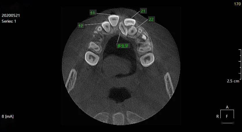 罗xx20200521多生牙cbct137xxxx3333