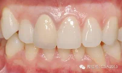 对比一下正常的牙龈颜色,您的牙龈健康吗?