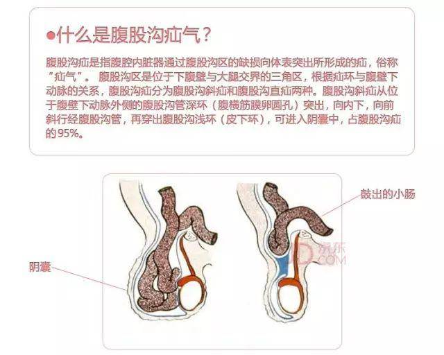 腹腔镜小儿腹股沟疝疝囊颈高位结扎术后康复注意事项