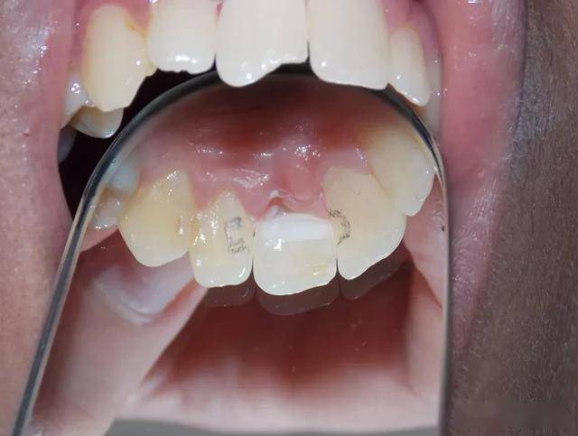 一例自体牙直接粘结桥修复11缺失病例_牙齿
