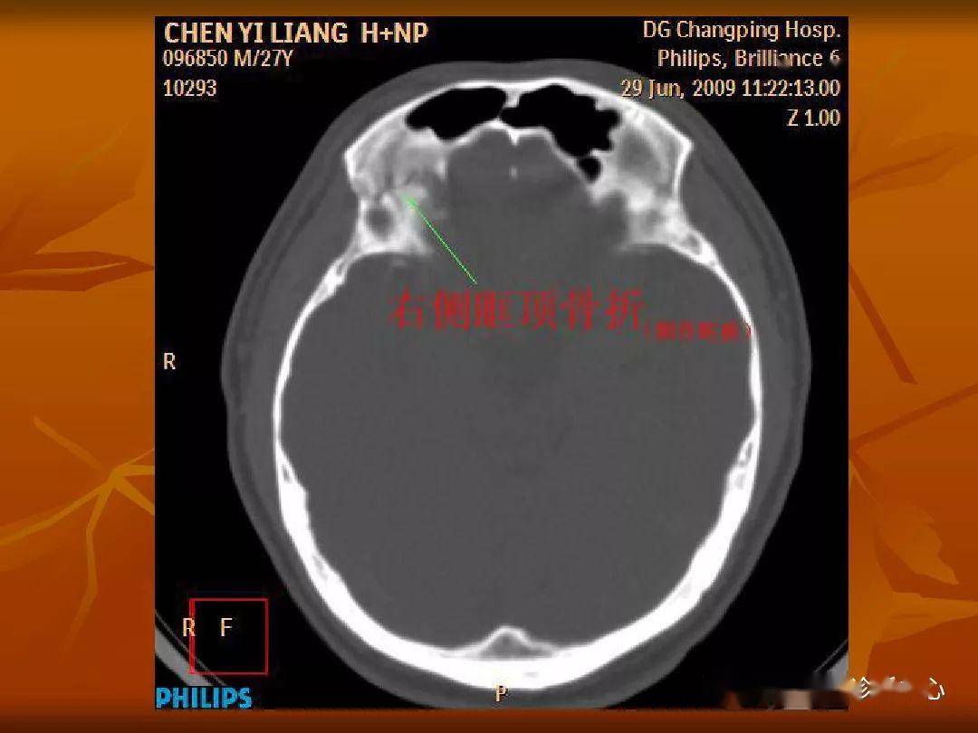 颅骨外伤性骨折ct诊断