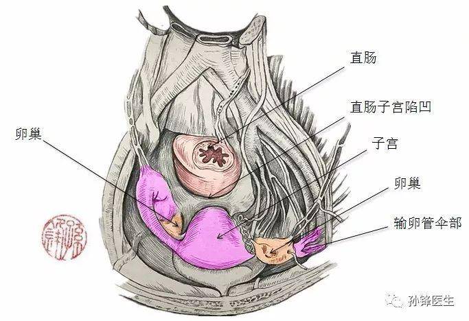 清楚了直肠和子宫之后,我们发现,在女性膀胱和子宫之间有膀胱子宫陷凹