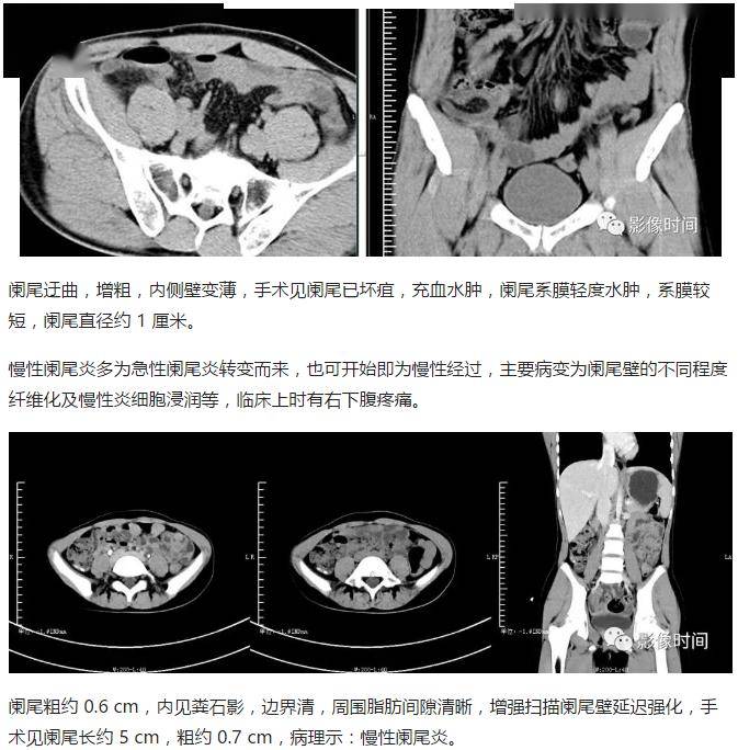 急性阑尾炎 ct 表现