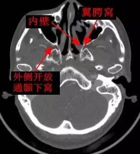 一文搞懂复杂解剖:翼腭窝