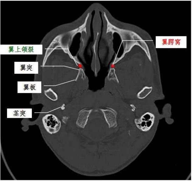 一文搞懂复杂解剖:翼腭窝_上颌