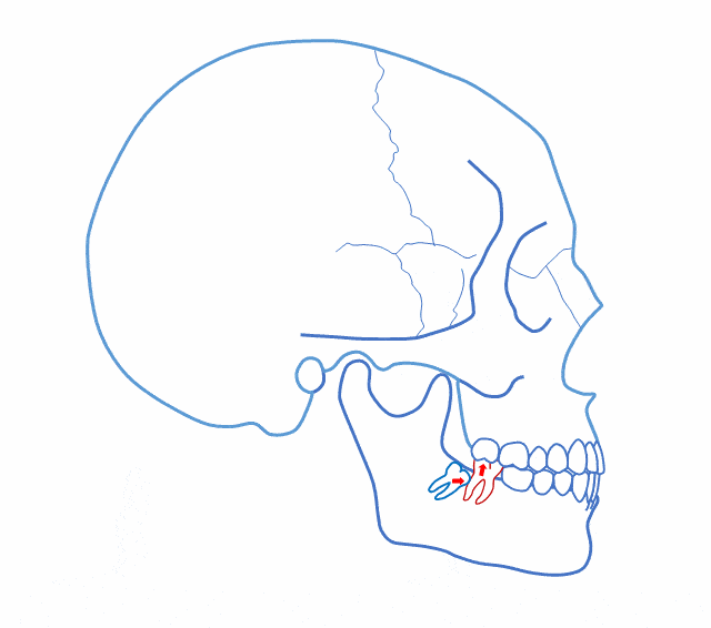 作为牙医当你还在犹豫患者智齿该不该拔的时候看这里