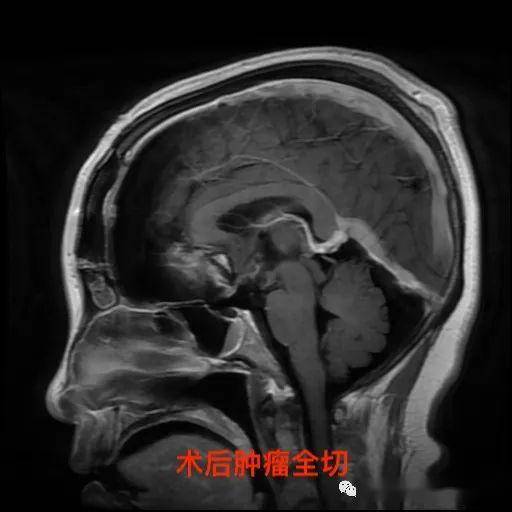 视物模糊要警惕鞍区肿瘤的可能