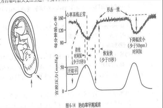 早期减速形状比较一致,与宫缩同时出现.其发生与宫缩形成镜像图像.