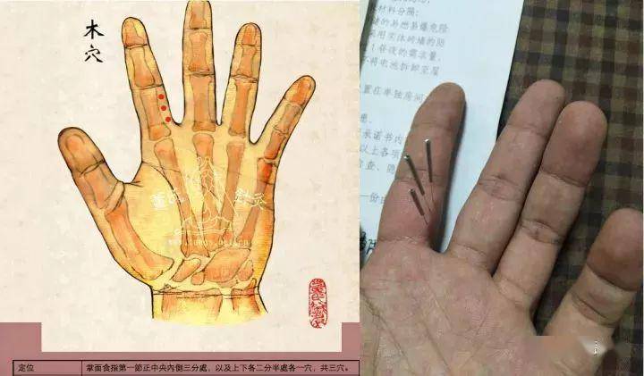 董氏针灸盗汗处方