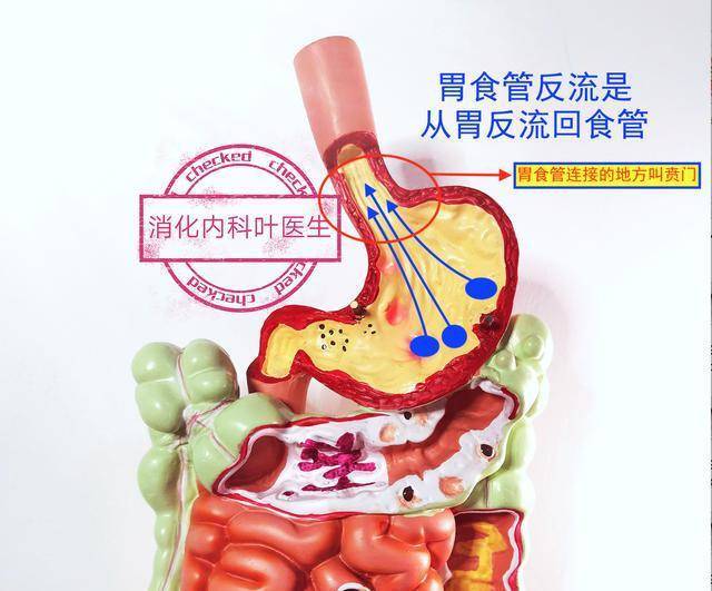 胃食管反流做胃镜能不能看出来想确诊需要做什么检查医生科普