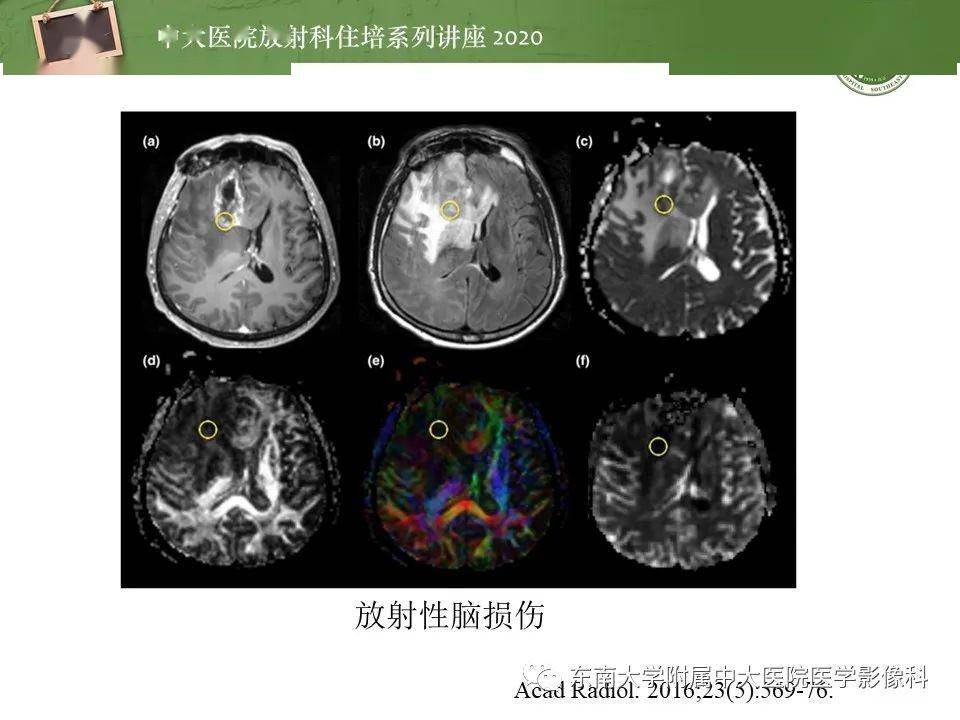 【中大放射住培系列讲座】胶质瘤复发与放射性脑损伤mr鉴别