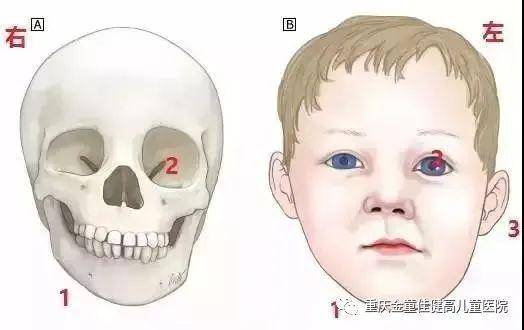 则面部肌肉发育较差,逐渐会一边脸大一边脸小,这样孩子的脸就不对称了