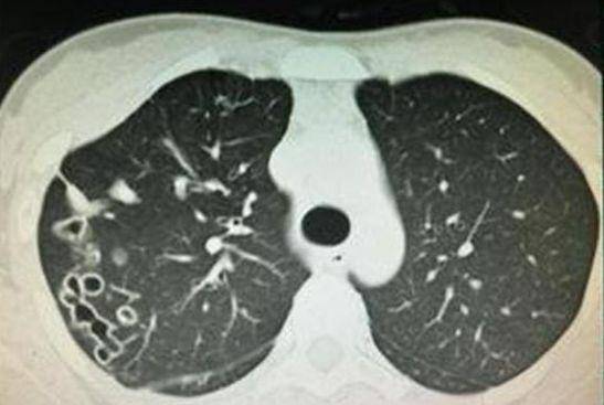 寄生虫|夏季这几种食物家长不要再给孩子吃了！8岁男童肝脏内长满了虫子