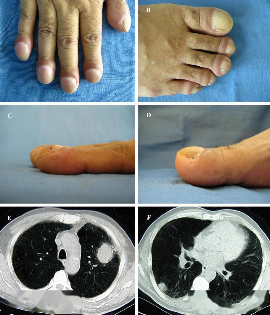 (与肺癌相关的杵状指(趾)) 还有一些肺癌患者中,当病灶在体内快速