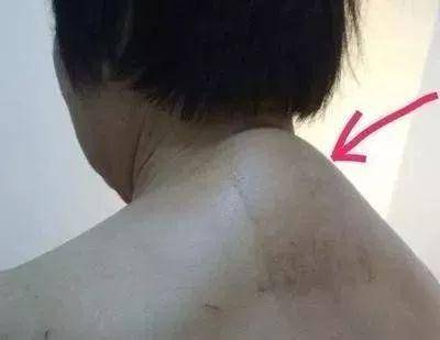 仅用三步,调理颈椎大包!