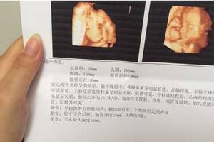 四维彩超除了留念,还藏着胎儿的很多"小秘密",看懂了吗?