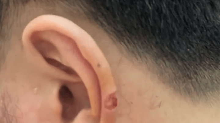 男子理发时耳朵被剪掉一块肉,理发店只付200元医药费,合理吗?