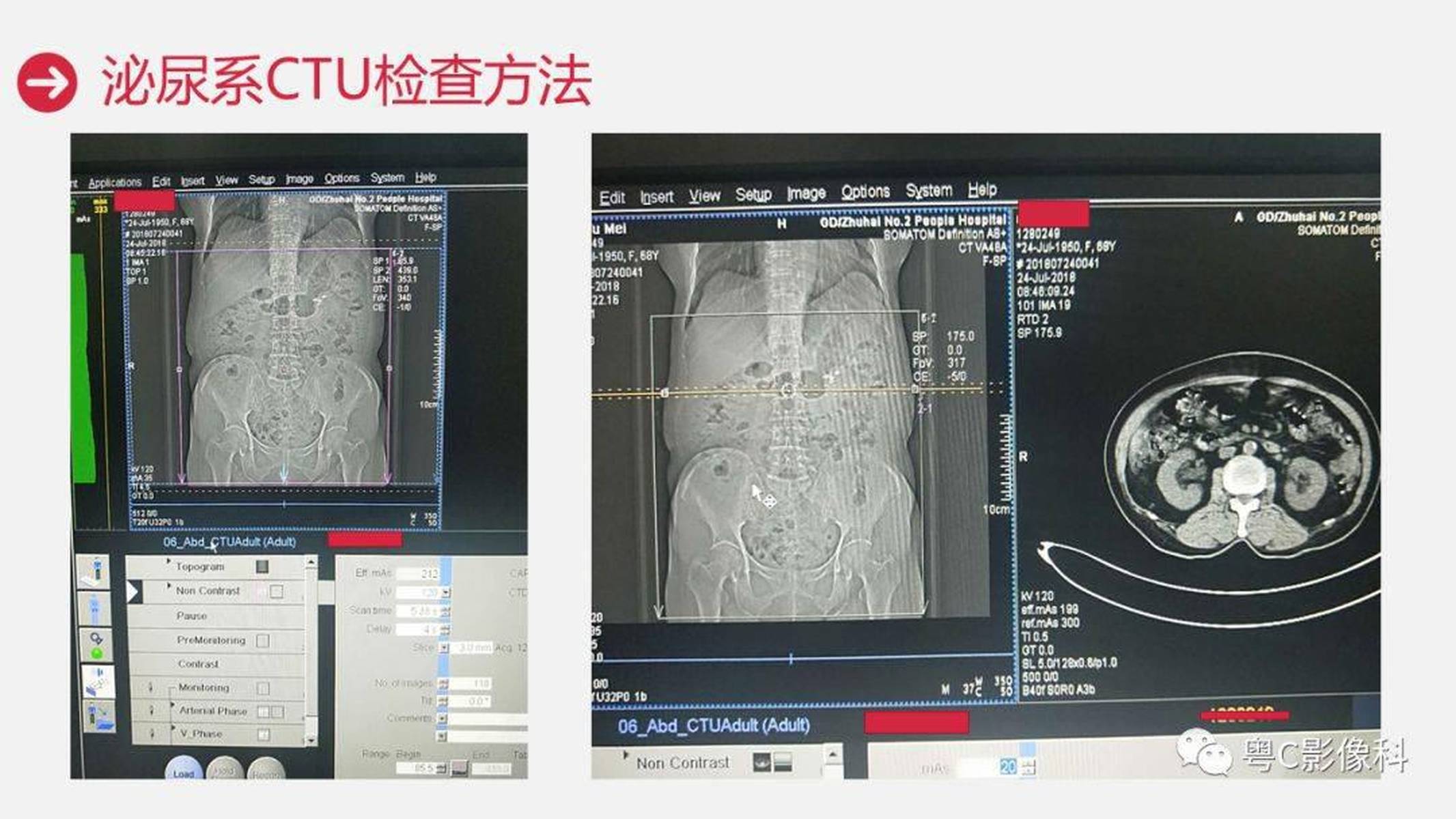 泌尿系ctu扫描技术
